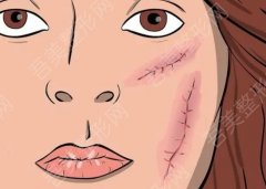 治疗脸上痤疮方法有哪些？如何预防痤疮的再次复发呢