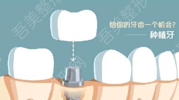 牙齿种植hg011.jpg