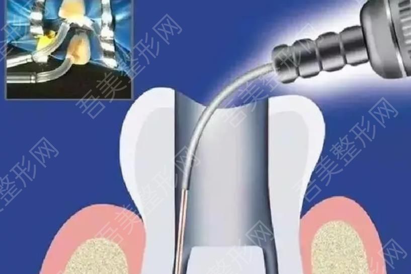 牙齿根管治疗卡通图04.jpg