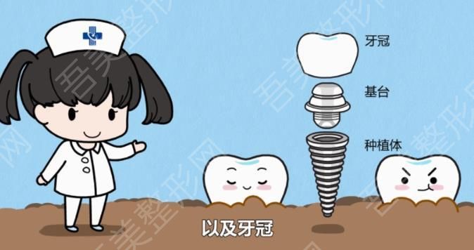 牙齿种植dm01.jpg