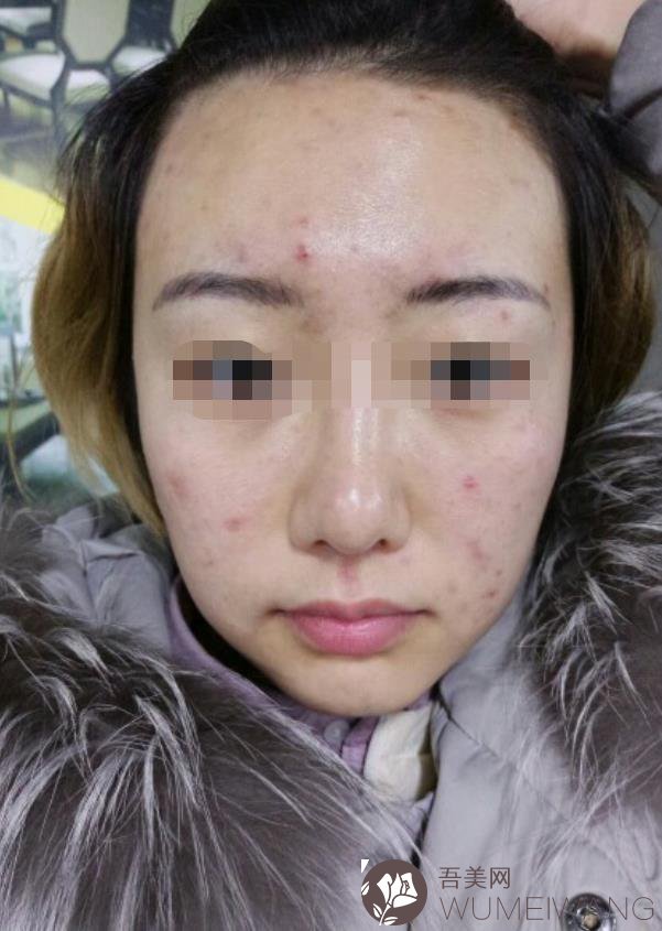 甘肃省人民医院皮肤科激光祛痘案例