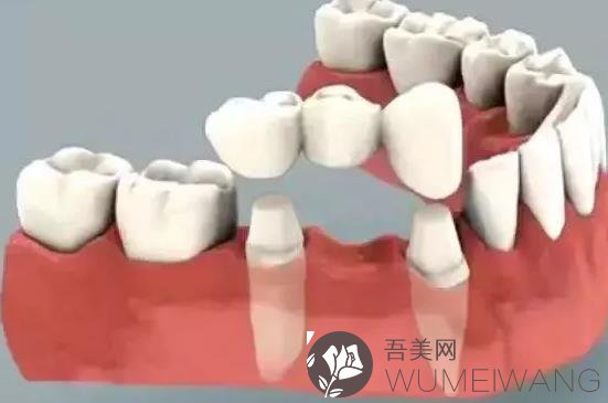 牙齿种植修复全过程