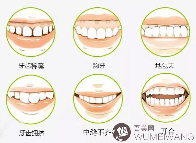 上海九院口腔科医生牙齿矫正相关科普