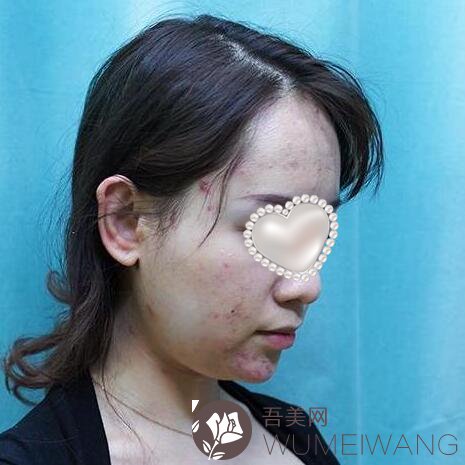 广安华美之星医疗美容门诊部双下巴吸脂案例