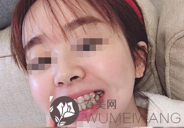 北京大学口腔医院牙齿矫正案例分享