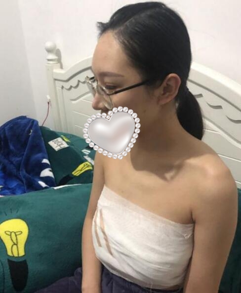 北京叶子整形医院隆胸案例