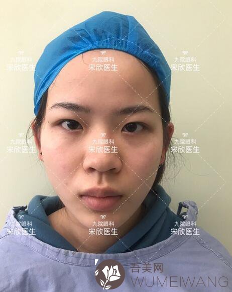 上海九院宋欣医生双眼皮修复案例图