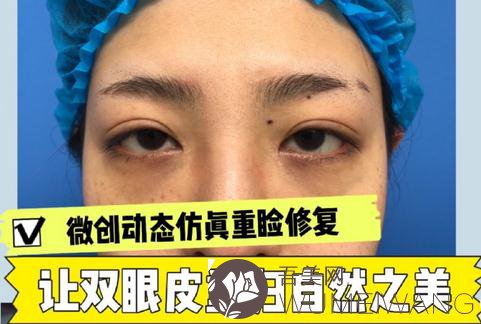 上海葛敏双眼皮修复案例