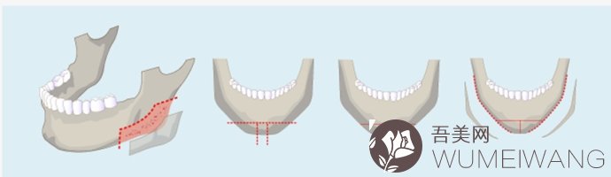 下颌角磨骨的风险有什么?