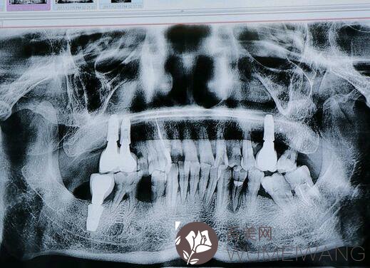 杭州牙齿种植案例精选