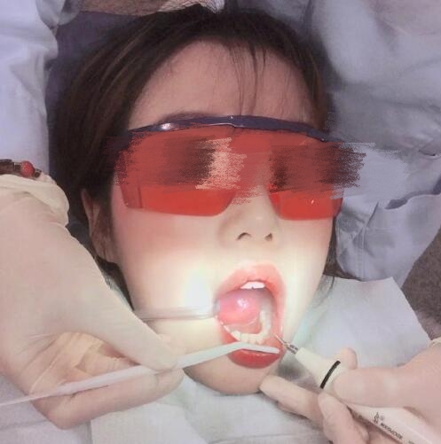 四川省人民医院口腔科牙齿矫正案例分享