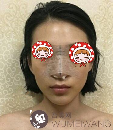 内江洋子美容整形医院鼻整形案例