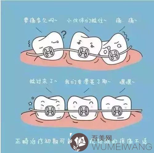 牙齿矫正的牙套有哪几种?