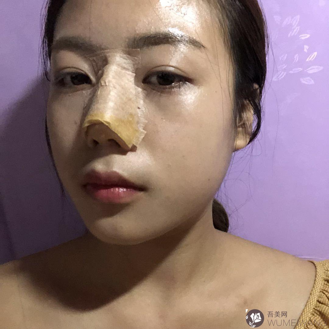 北京柏丽李劲良隆鼻整形的案例分享：术后恢复期间