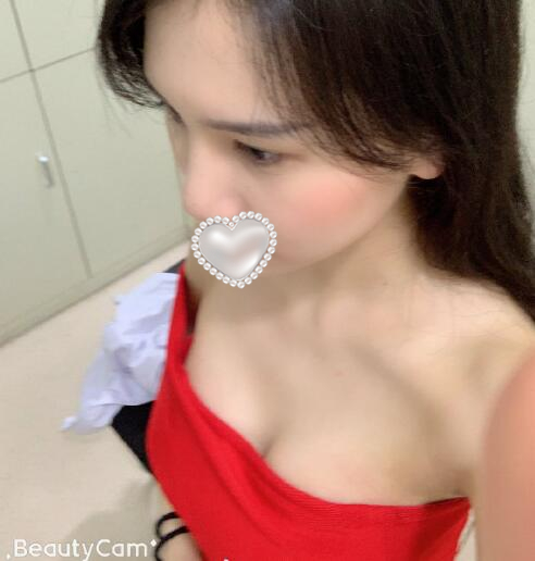 北京艺星医疗美容医院隆胸案例分享北京艺星医疗美容医院隆胸案例分享