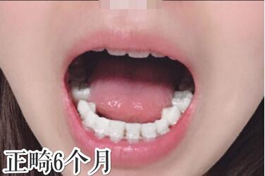 中山香山口腔医院牙齿矫正案例分享