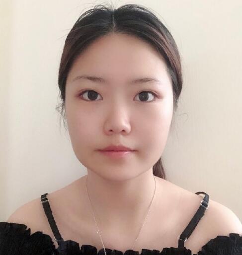 北京联合丽格医疗美容医院磨骨案例分享