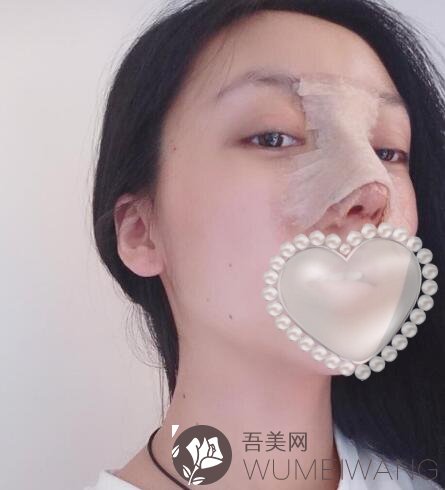 内江百龄京菊医疗美容门诊部鼻整形案例