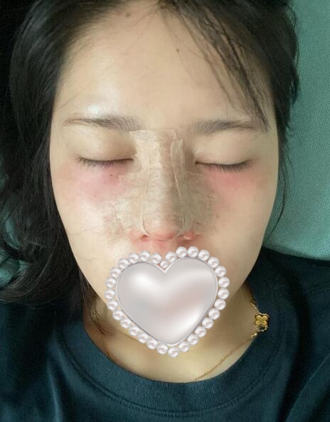 北京丽都医疗美容医院隆鼻案例分享