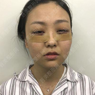 黄秀珍医生去眼袋案例分享：术后恢复