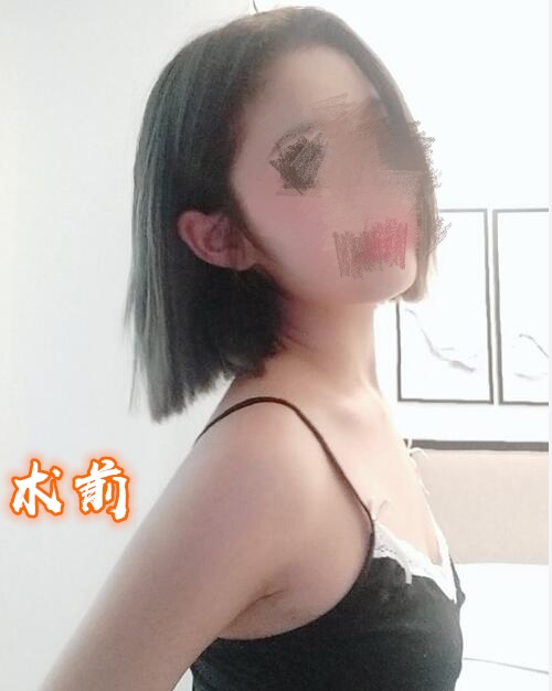 北京联合丽格医疗美容医院隆胸案例分享