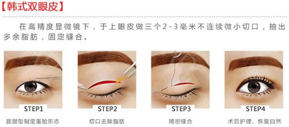 北京大学人民医院整形美容科科普双眼皮