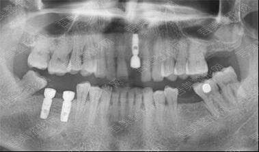 成都极光口腔门诊部种植牙案例
