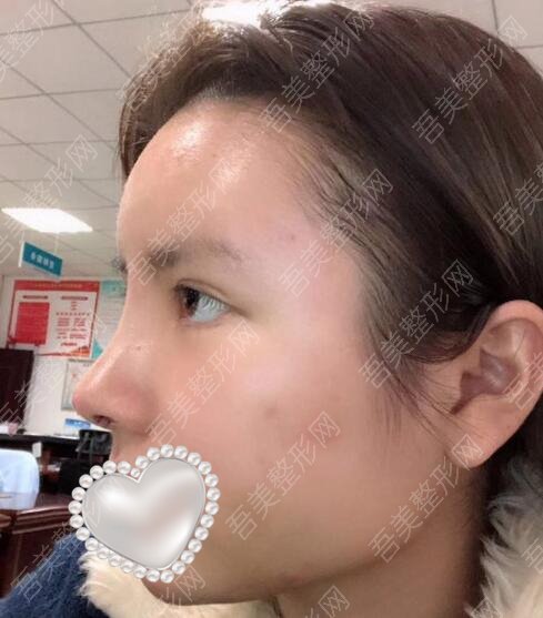 江油莱美尔整形美容医院鼻部修复案例