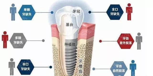 上海九院种植牙一颗多少钱?