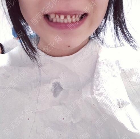 上海九院牙齿种植真实案例分享：术前