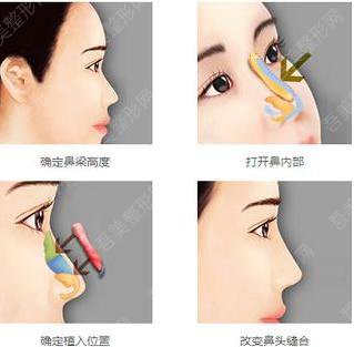 膨体隆鼻手术的优势