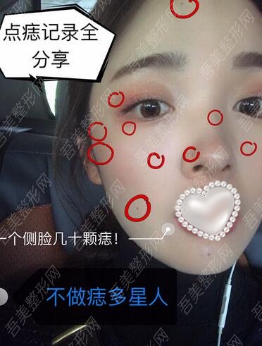 重庆小珂丽格医疗美容诊所激光点痣案例