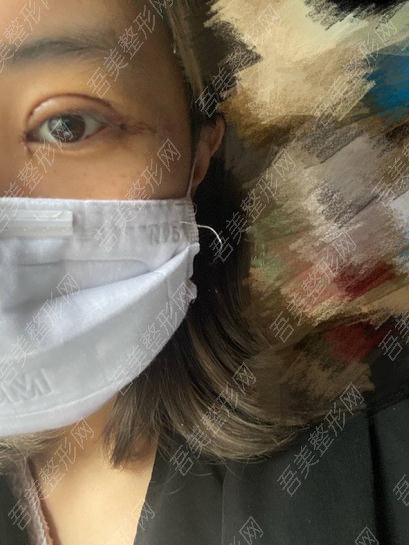 刚做了双眼皮手术的照片|网友亲身经历分享：术后3天