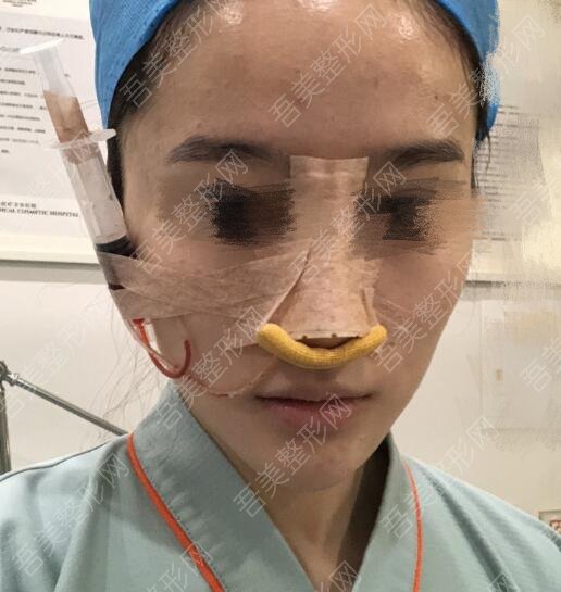 重庆星天地医疗整形美容门诊部鼻整形案例