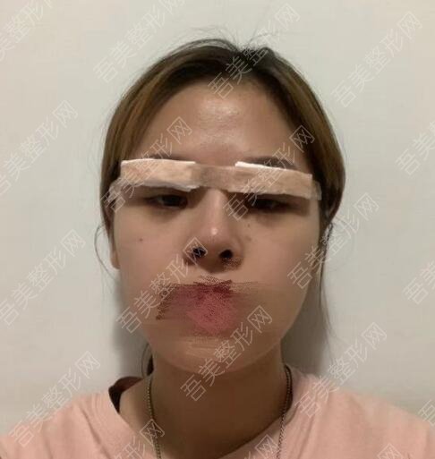 重庆星天地医疗整形美容门诊部双眼皮修复案例
