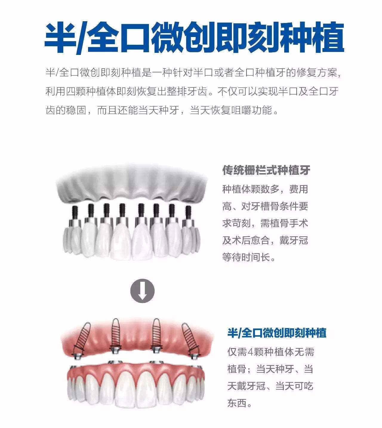 种植牙手术步骤和护理