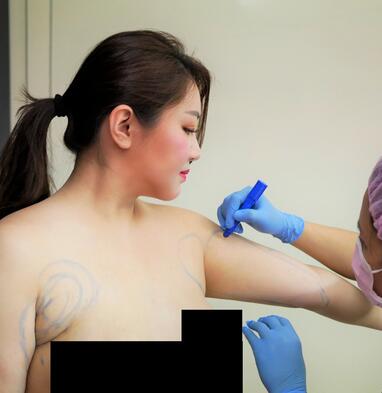 南京医科大学友谊整形外科医院吸脂案例分享