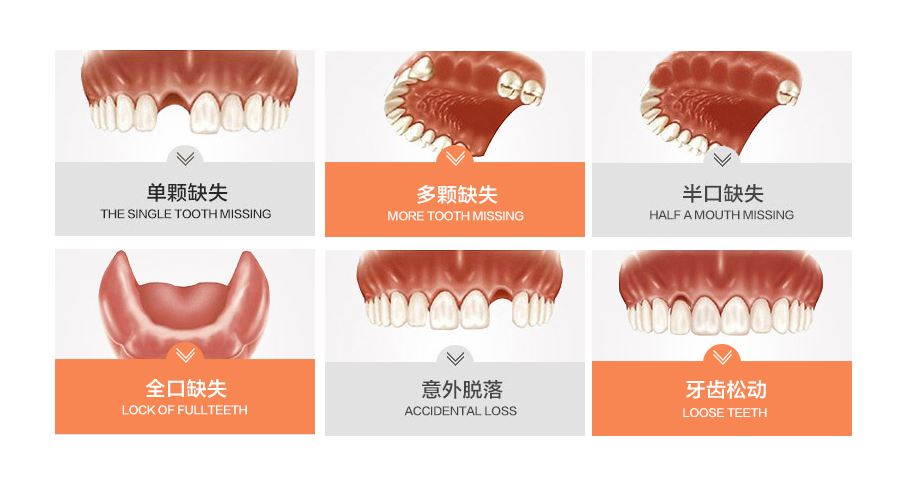 上海九院口腔科科普种植牙手术知识