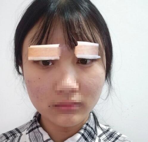 上海长征医院整形外科眼部整形案例分享
