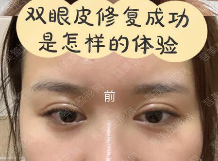 甘肃省人民医院整形科薛晓东医生双眼皮案例