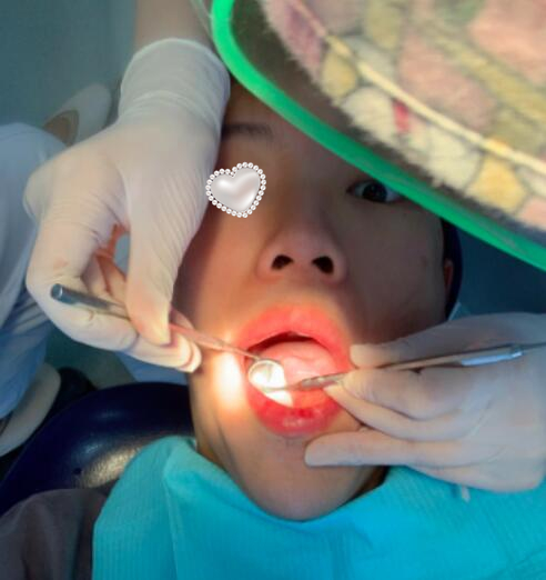 西安中诺口腔医院种植牙案例