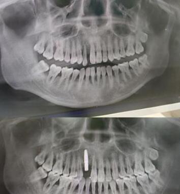 西安中诺口腔医院种植牙案例