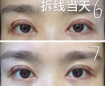 徐敦医生双眼皮修复案例分享