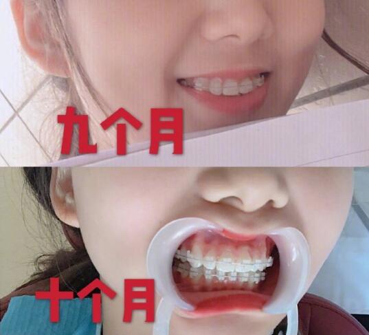 广州中家医家庭医生口腔医院牙齿矫正案例分享