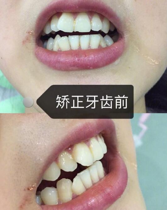 广州中家医家庭医生口腔医院牙齿矫正案例分享