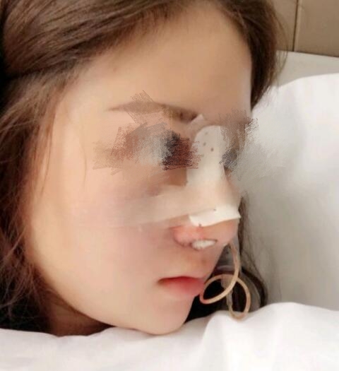 南华大学附属第一医院烧伤整形外科隆鼻案例分享