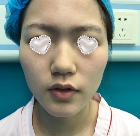 上海市第九人民医院整复外科隆鼻案例欣赏