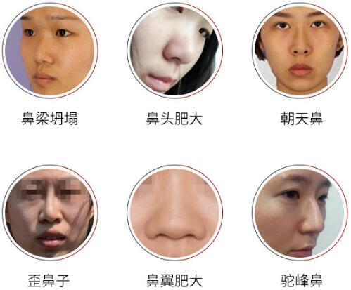 上海第九人民整形外科余力医生讲解隆鼻