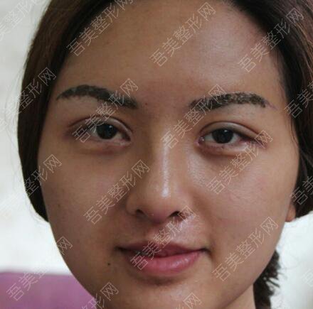 天津市天津医院整形外科双眼皮案例