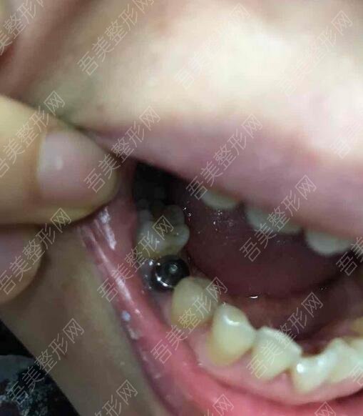 天津海德堡联合口腔医院牙齿种植案例